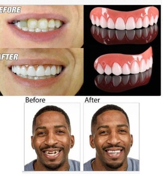 طقم اسنان مؤقت perfect smile ابتسامة هوليود مع منتج بيرفكت سمايل اسنان علوية 3